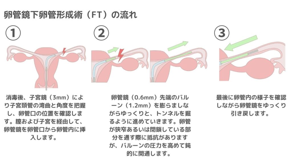 FT（卵管鏡下卵管形成術）は“誰に向いている？”