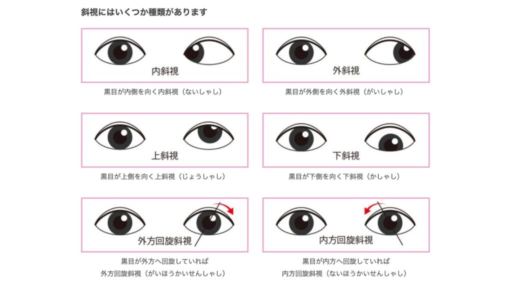 子どもの斜視は治る?症状の見分け方・原因・治療と受診の目安を専門医が解説